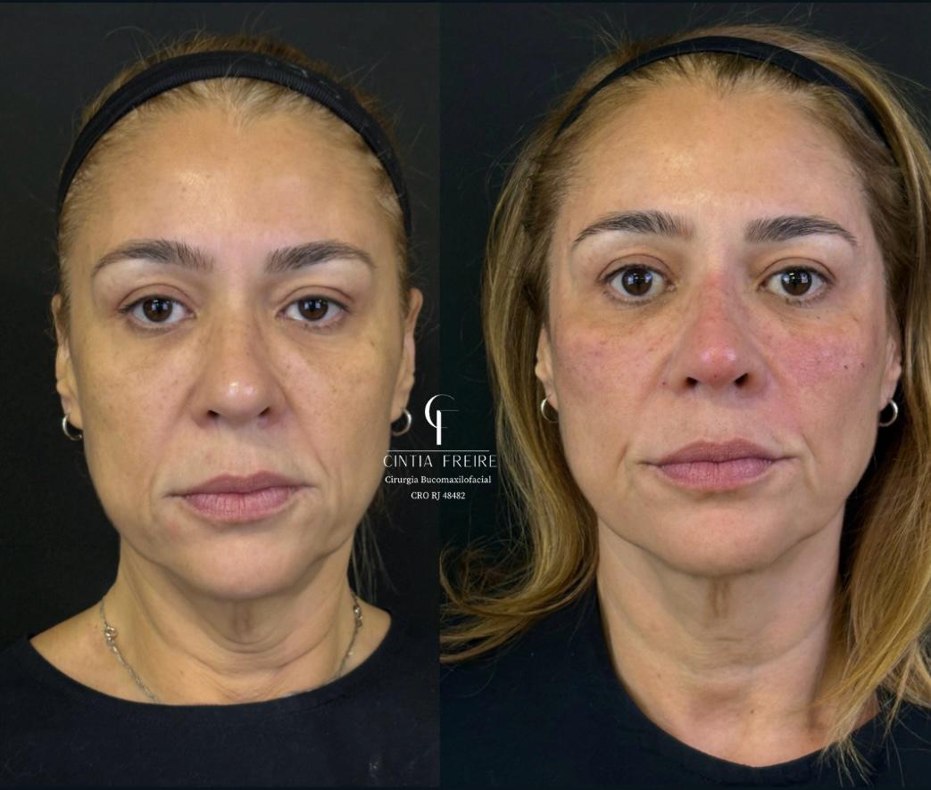 Rejuvenescimento Facial