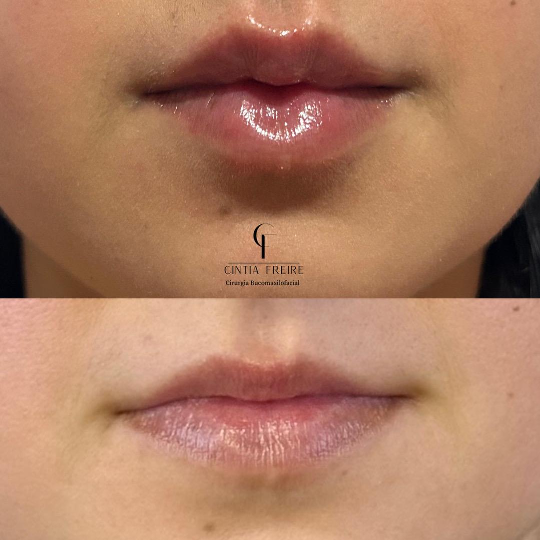 Harmonização Facial