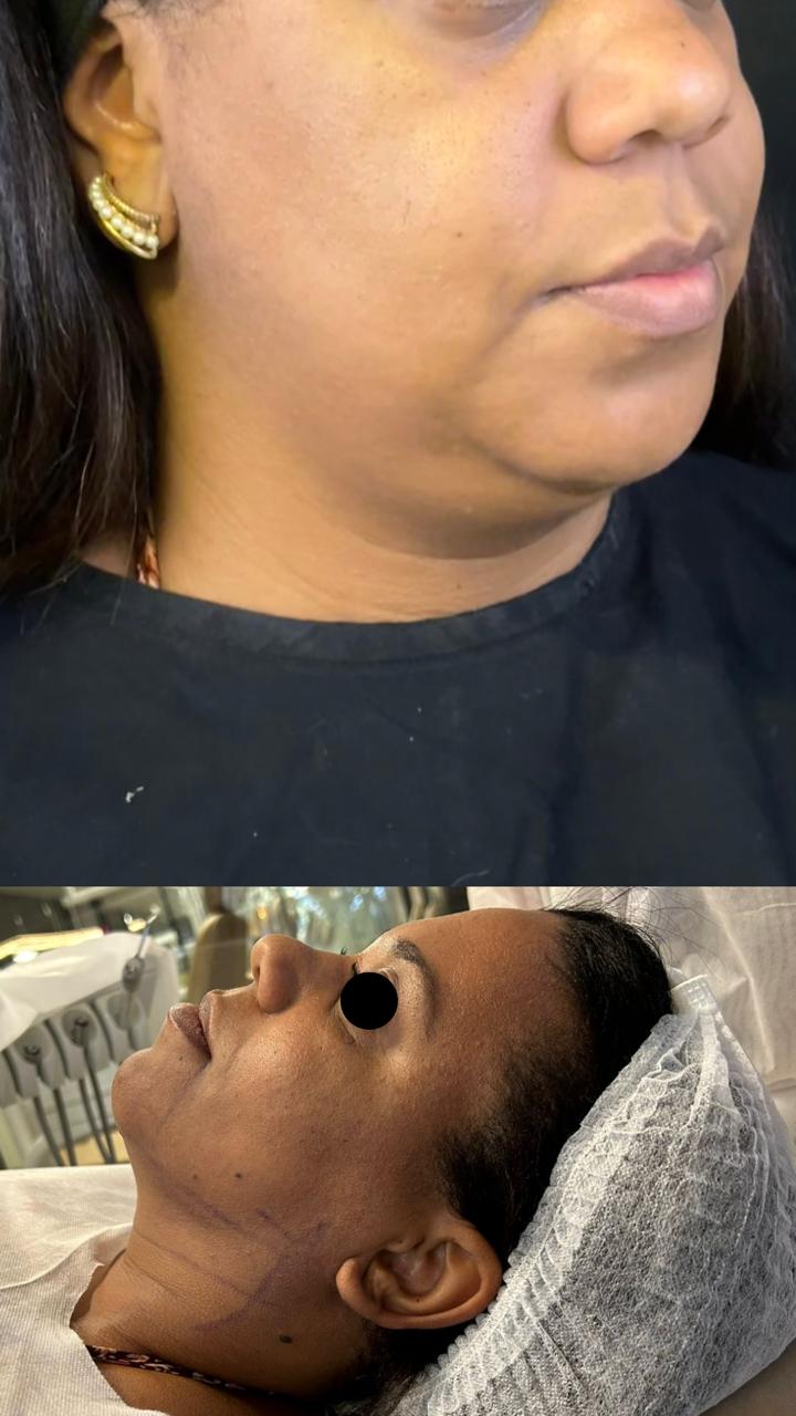 Papada